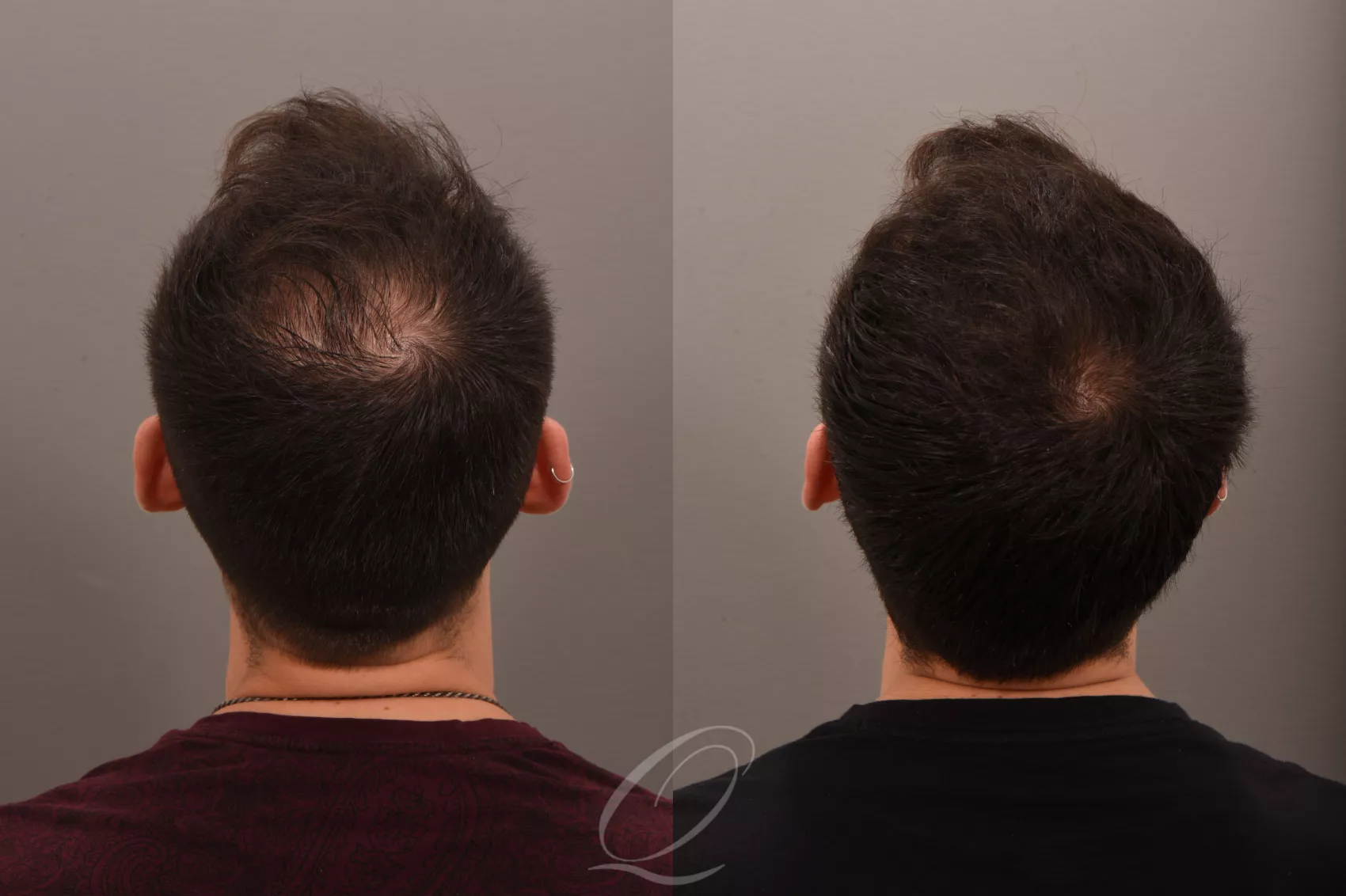 Finasteride