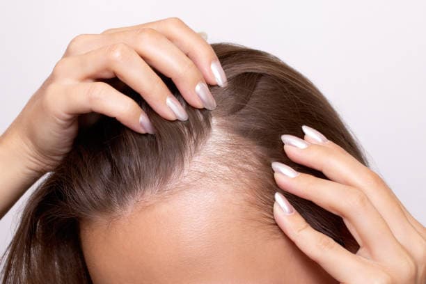 Hair Loss